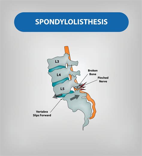 types  spondylolisthesis distinguishing  congenital isthmic