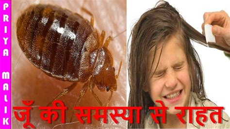 How To Get Rid Of Head Lice Naturally Best Home Remedy For Removing Of Beauty Tips For Hair