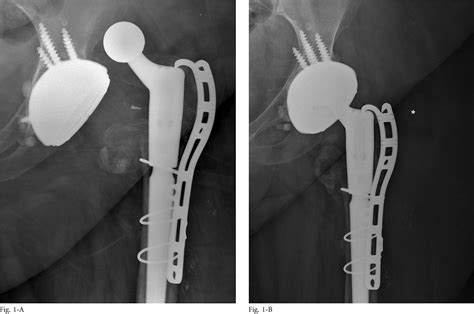 Figure From Intraprosthetic Dislocation Of Dual Mobility Bearings