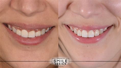 Laser Gum Contouring For Gummy Smile Treatment In Toronto