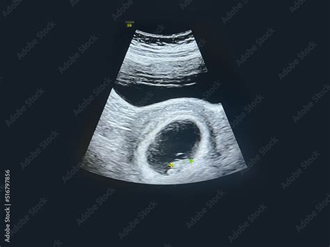 Little baby ultrasound at 8 weeks gestation ultrasound images of the ...