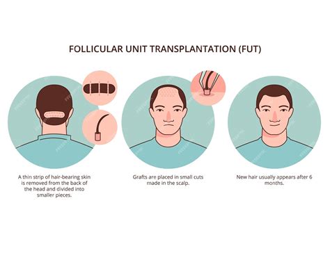 Free Vector Hand Drawn Hair Transplant Infographic