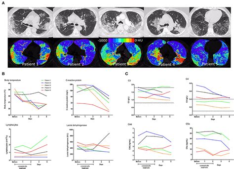 Frontiers Treatment Of COVID 19 With Conestat Alfa A Regulator Of