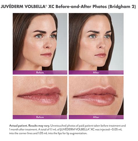 Juvederm Voluma In Lips | Lipstutorial.org