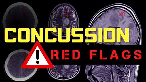 Red Flags For A Concussion Youtube