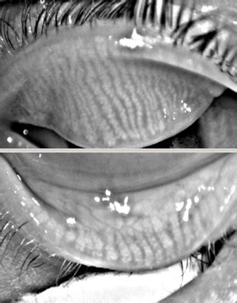 MEIBOMIAN GLAND IMAGING AND EXPRESSION – Dry Eye Equation