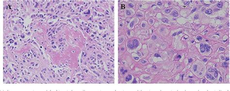 Figure 1 From Osteosarcoma Of The Patella Mimicking Giant Cell Tumor