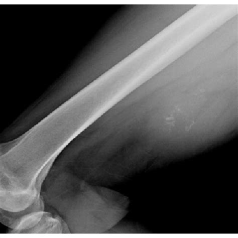 T2-weighted sagittal MRI of the thigh demonstrating a large, posterior... | Download Scientific ...