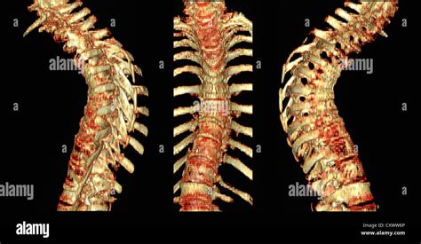 CT Scan Of Thoracic Spine With Osteoporosis Stock Photo Alamy