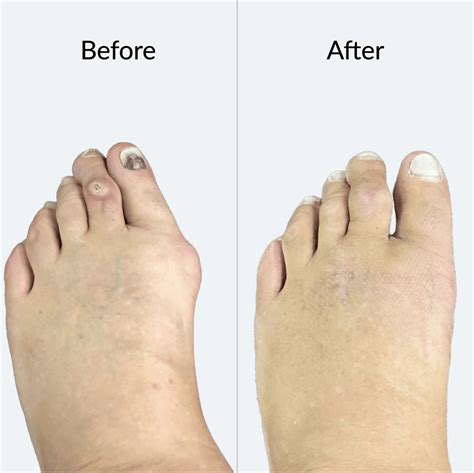 Bunion Correction Procedure Dr Mugrabi Clinic