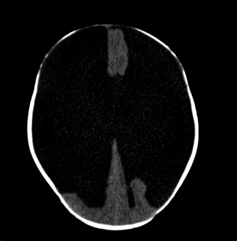 Hydranencephaly Image