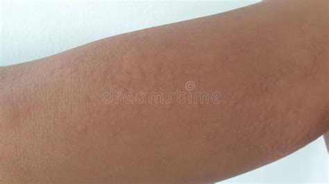 Rash Swelling from Allergic on Arm, Rod Allergy Stock Photo - Image of ...