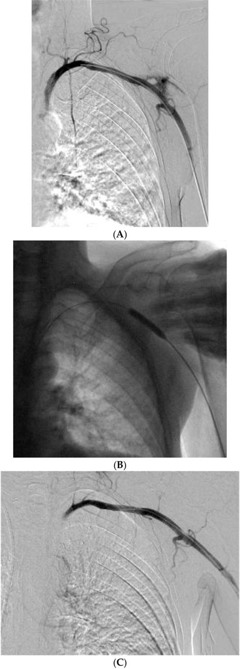 [PDF] Management of Inadvertent Arterial Catheterization during Central Venous Catheter ...