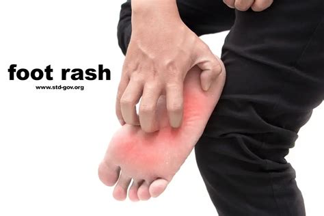 Foot Rash Causes Symptoms Home Remedies And Treatment Pictures