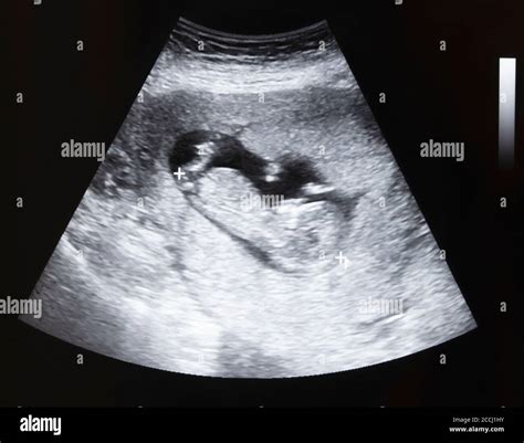 Ultrasound of baby in pregnant woman Stock Photo - Alamy