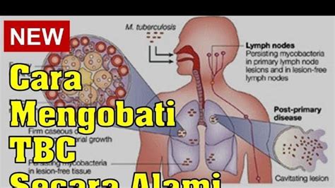 Cara Mudah Dan Ampuh Mengatasi Tbc Dengan Cepat Dengan Cara Merubah