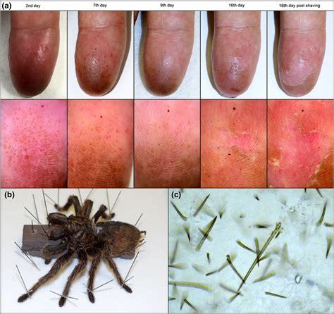 Image Gallery Contact Dermatitis Resulting From Tarantula‐hair Injury