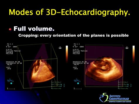 PPT Three Dimensional Echocardiography In The Clinical World