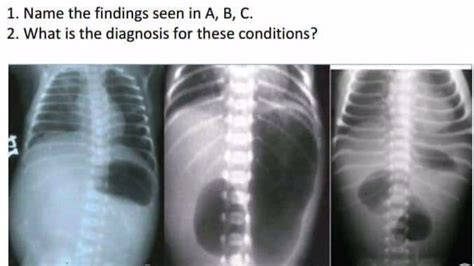 Diagnostic Clue For Intestinal Obstruction Chips Duodenal Atresia