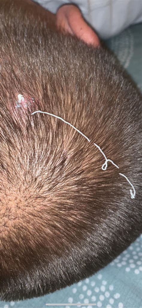 Boyfriend said that he felt like his Pilar cyst was ready to pop...I