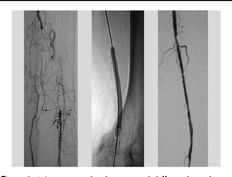 Figure 3 From A Review Of Superficial Femoral Artery Angioplasty And Stenting Semantic Scholar