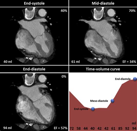 Assessment Of Left Ventricular Ejection Fraction With Late Systolic And