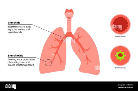 Bronchitis And Bronchiolitis Illustration Stock Photo Alamy