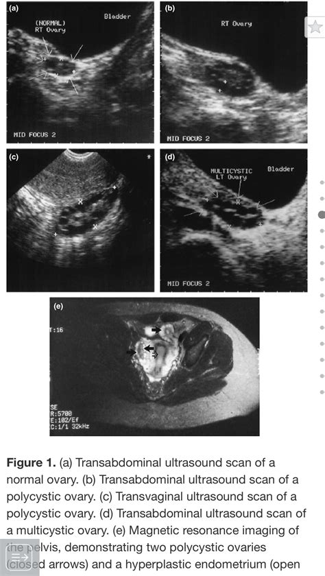 TOG article – PCOS | Medgyne