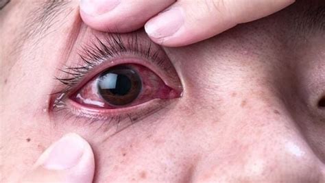 Cườm nước Glaucoma là gì Nguyên nhân triệu chứng