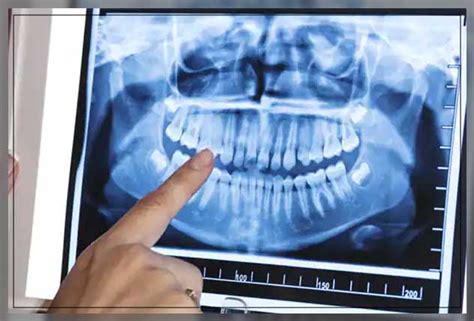 Hyperdontia Causes, Symptoms and Treatment - Dentist Ahmed