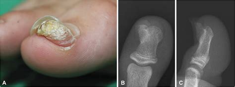 Protruding Hyperkeratotic Tumor Underneath The Big Toe Nail The American Journal Of