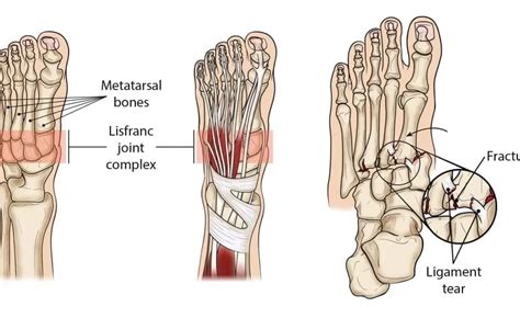 Lisfranc dislocation Archives - Samarpan Physiotherapy Clinic