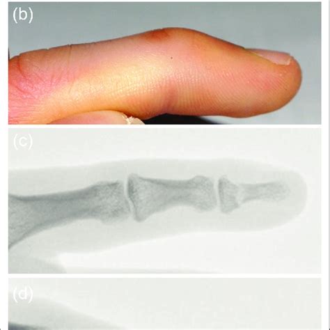 (PDF) Distal phalanx fracture in adults: Seymour-type fracture