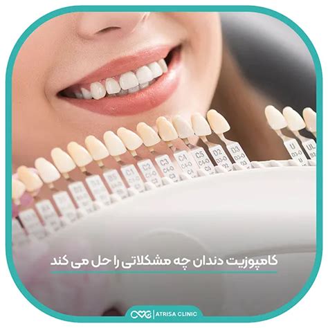 کامپوزیت دندان | کلینیک آتریسا