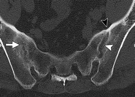 Sacroiliitis Associated With Axial Spondyloarthropathy New Concepts