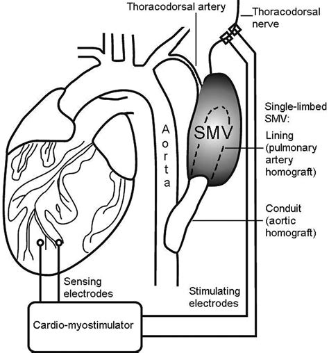 Counterpulsation From The Skeletal Muscle Ventricle And The Intraaortic