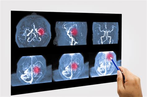 Angiography | MedicusUnion