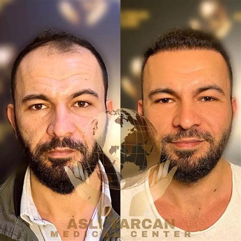 Hair Transplant Turkey Before After Asli Tarcan Clinic