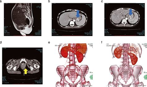 Sagittal Magnetic Resonance Imaging Mri Scan Showing A Large Uterine Download Scientific