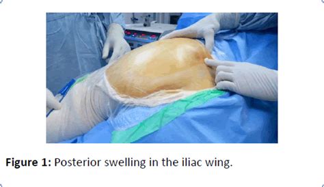 Gluteal Abscess