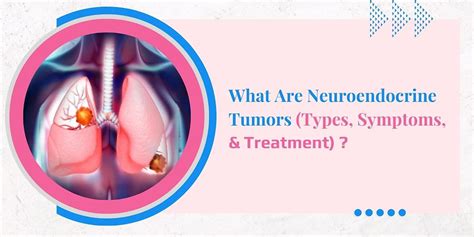 WHAT ARE NEUROENDOCRINE TUMORS (TYPES, SYMPTOMS, AND TREATMENT)?