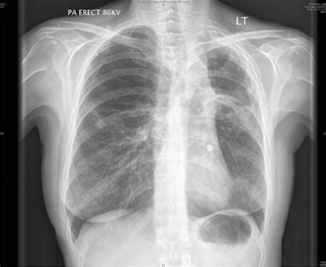 Chest X-ray of an ex-smoker (30 pack-years) patient with COPD and ...