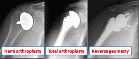 Shoulder Replacement Pacific Orthopedics And Sports Medicine