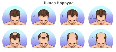 Сколько графтов нужно для пересадки волос - Клиника Heva