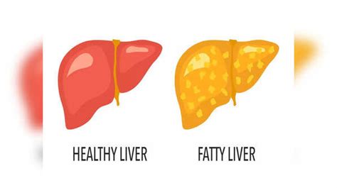 Fatty Liver Disease How To Identify If You Have Fatty Liver