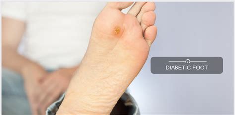 Diabetic Foot Infections – Bengaluru Centre for Diabetic Foot and Podiatry