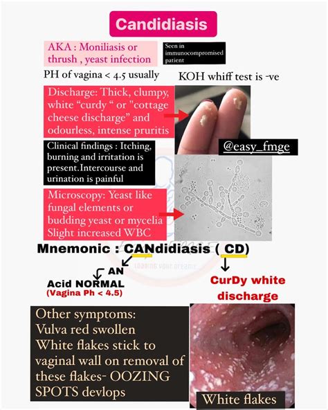 White Clumpy Discharge