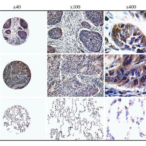 Expression Of Osteopontin Protein In Human NSCLC Immunohistochemical