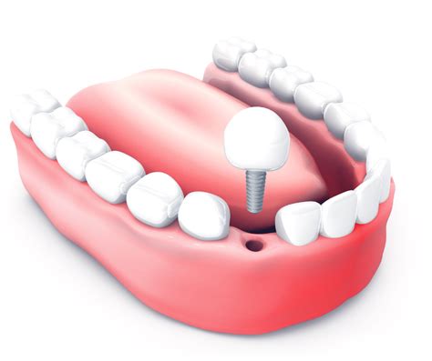 Te Contamos Los Beneficios De Los Implantes Dentales