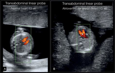 Fetal Cardiac Examination In Early Gestation Obgyn Key